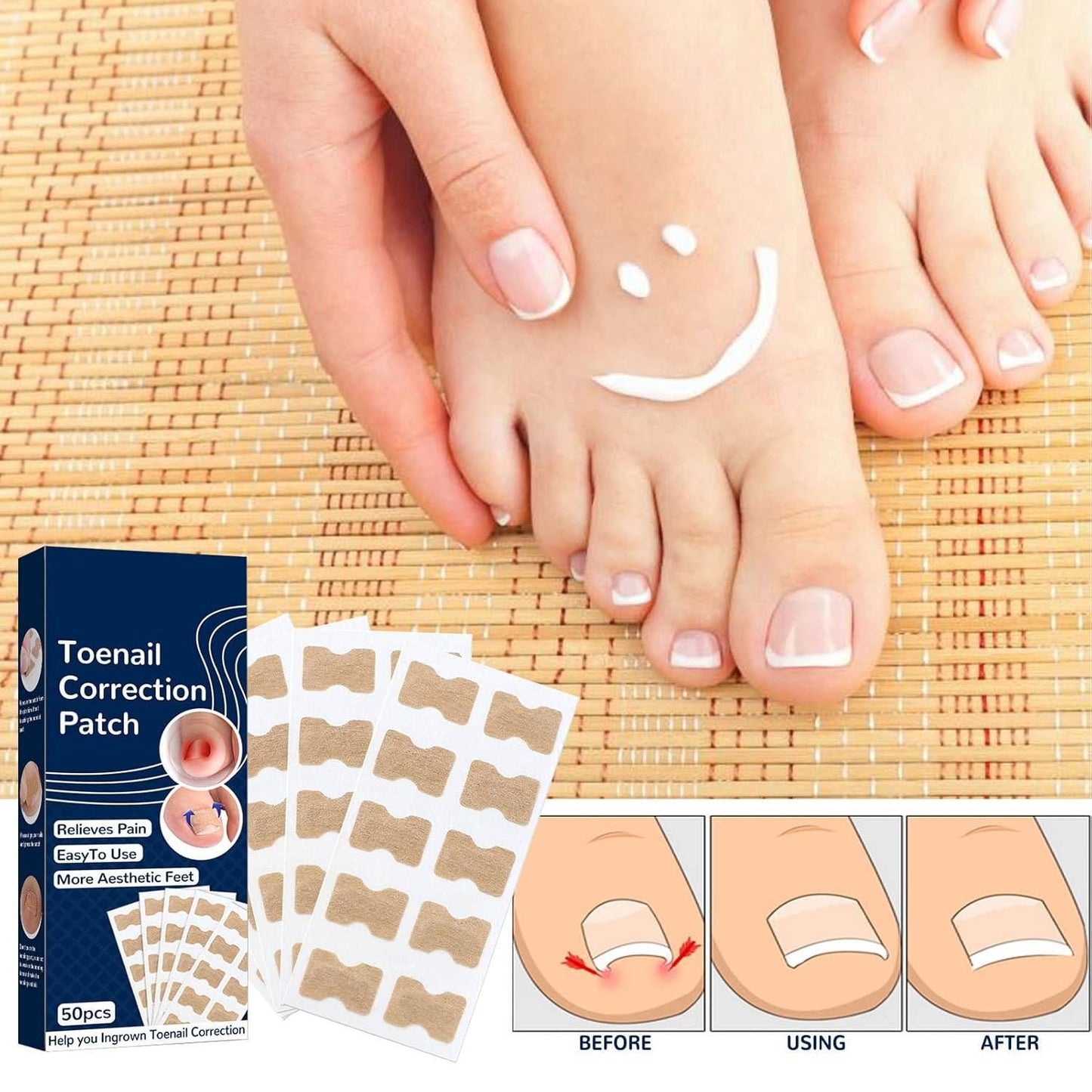 ZooZoo Ingrown Toenail Corrector Stickers (20g) - Painless Relief & Natural Alignment (One Size Fits Most, Random Color)